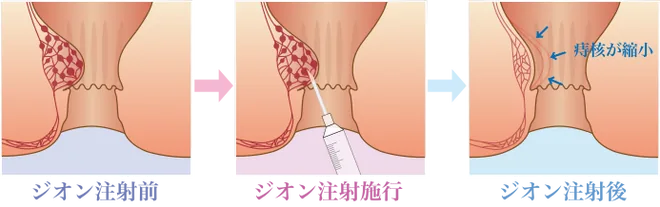 phẫu thuật trĩ về trong ngày ở Nhật